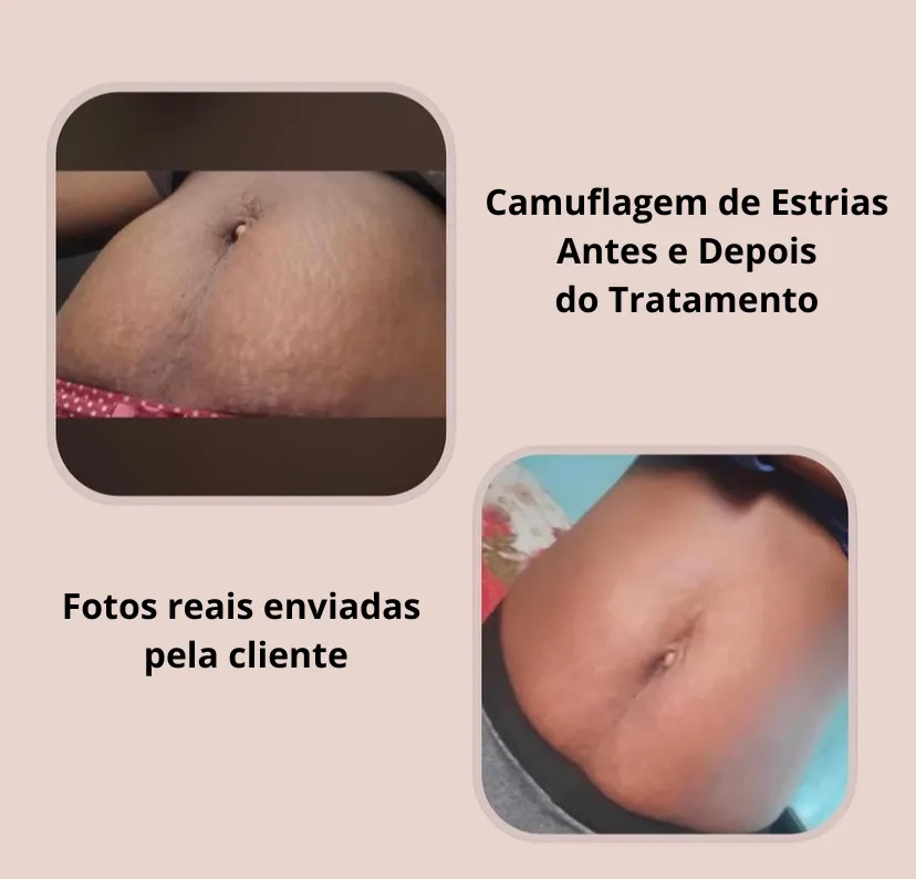 Tratamento ensinado no Curso de Camuflagem de Estrias da Tavarest Academy.