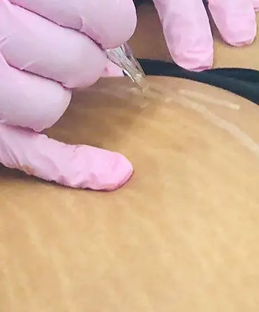 Imagem do Curso de Camuflagem de Estrias da Taverest Academy, mostrando a técnica de micropigmentação de estrias